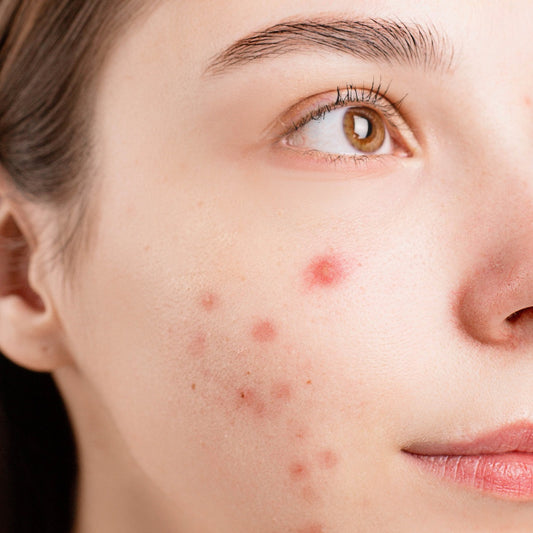 Q10 Anti-Acne Cream